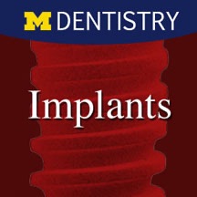 Implants - Two teeth cover