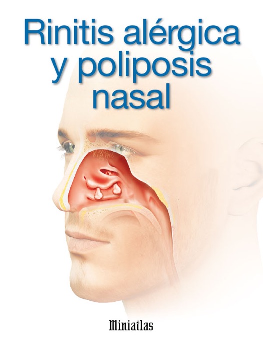 Rinitis alérgica y poliposis nasal