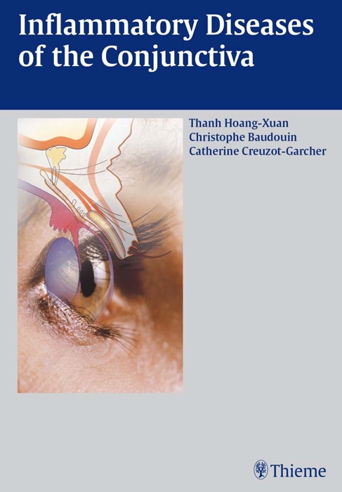 Inflammatory Diseases of the Conjunctivae