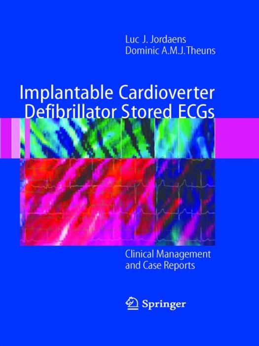 Implantable Cardioverter Defibrillator Stored ECGs