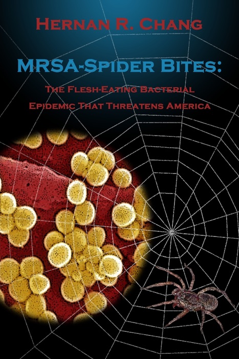 Mrsa-Spider Bites