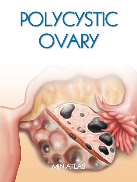 Polycystic Ovary Miniatlas