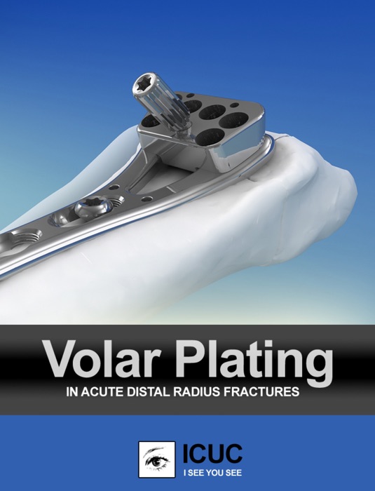 Volar Plating