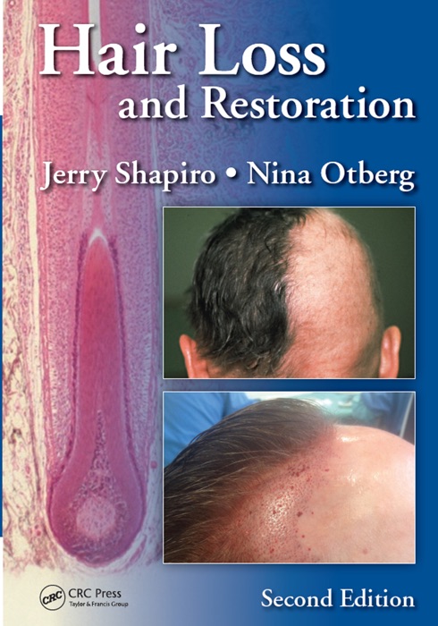 Hair Loss and Restoration