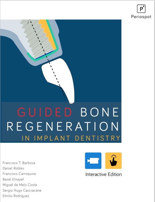 Guided Bone Regeneration