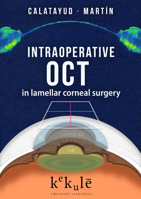 Intraoperative OCT in lamellar corneal surgery