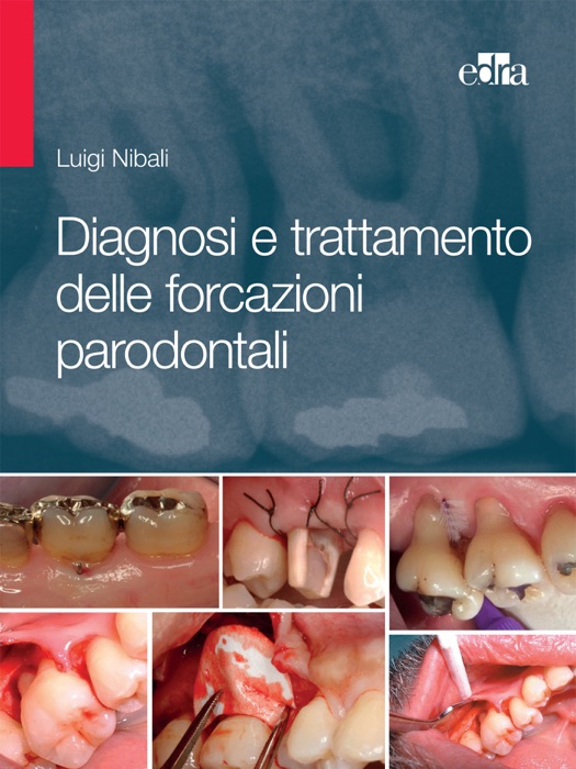 Diagnosi e trattamento delle forcazioni parodontali