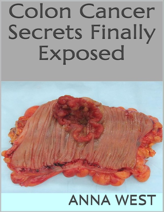 Colon Cancer Secrets Finally Exposed