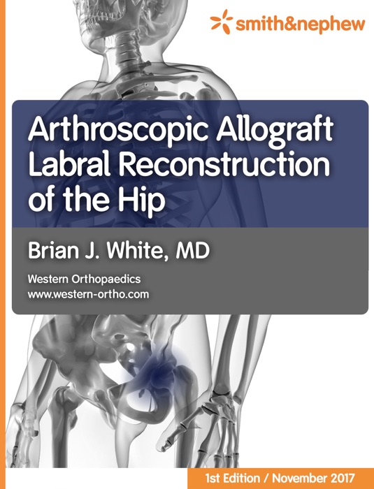 Arthroscopic Allograft Labral Reconstruction