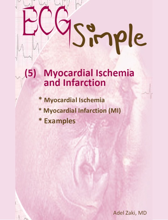 ECG Simple (5) Myocardial Ischemia and Infarction