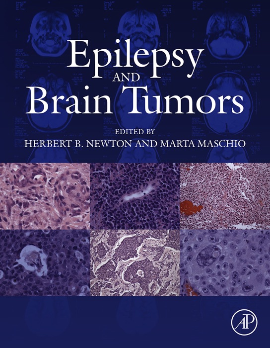 Epilepsy and Brain Tumors