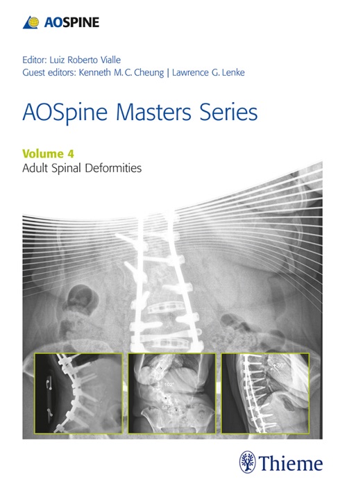 AOSpine Masters Series, Volume 4: Adult Spinal Deformities