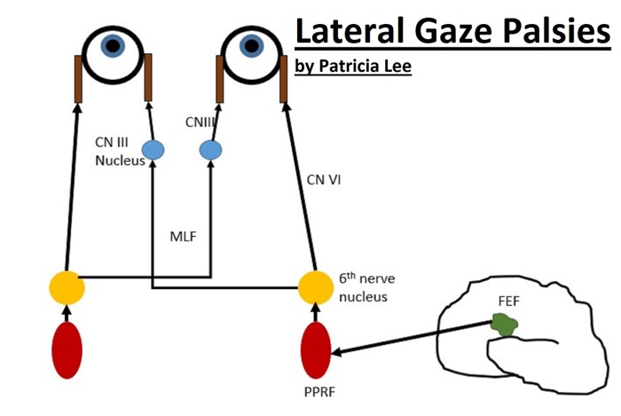 Lateral Gaze Palsies