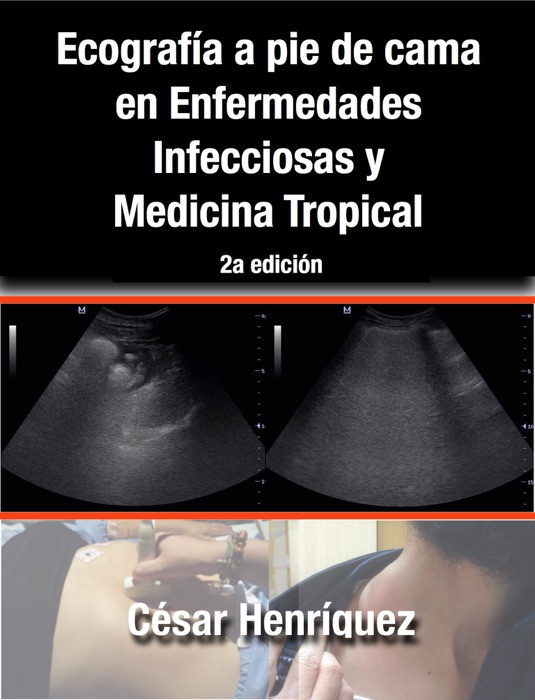 Ecografía a pie de cama en Enfermedades Infecciosas y