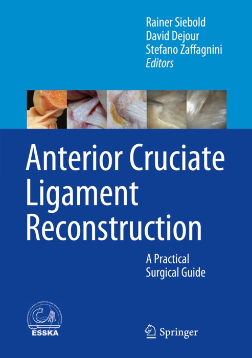 Anterior Cruciate Ligament Reconstruction