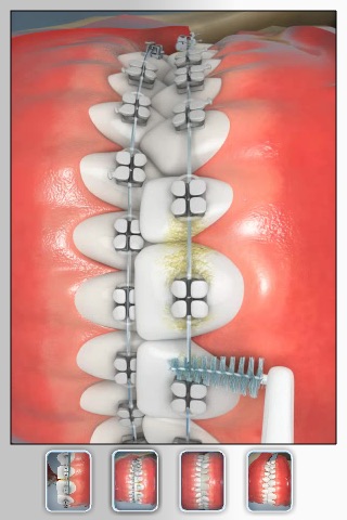 Dr. Boutin Orthodontics: CavityFree 3D screenshot-3