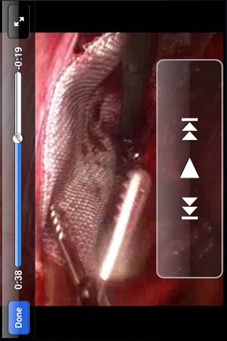 Laparoscopic Inguinal Hernia Repair screenshot 4