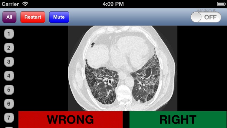 Chest Radiology Flashcards
