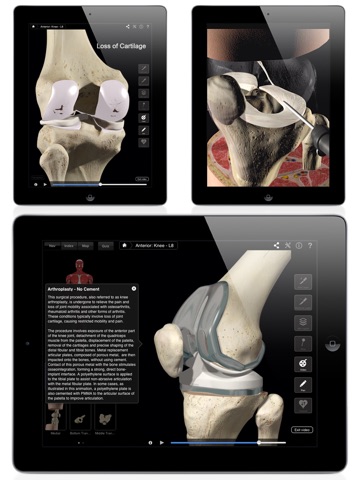 Knee Pro III for iPad screenshot 2