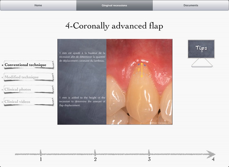 iMuco Gingival recessions