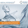 BurnCase 3D 2.0