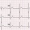 Learn how to read an EKG