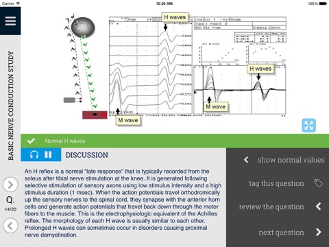 Learn EMG: An Interactive Quiz Approach to Electrodiagnostic Interpretation screenshot 2