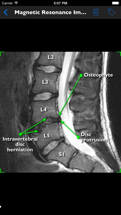 mLumbarDegenerativeDiscDisease screenshot-4