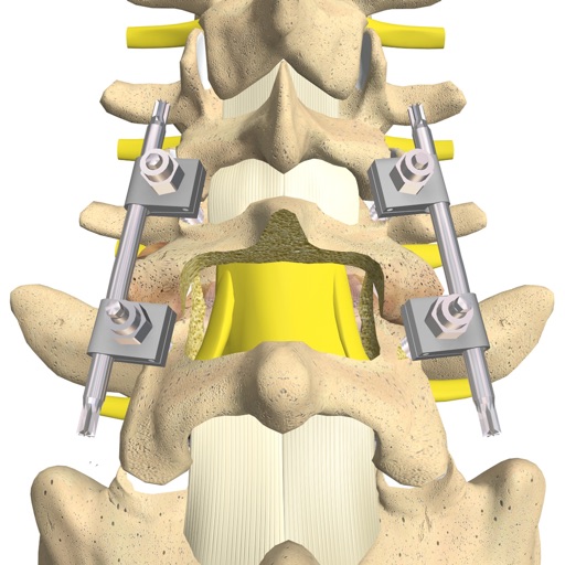 mLumbarPosteriorInterbodyFusionCage