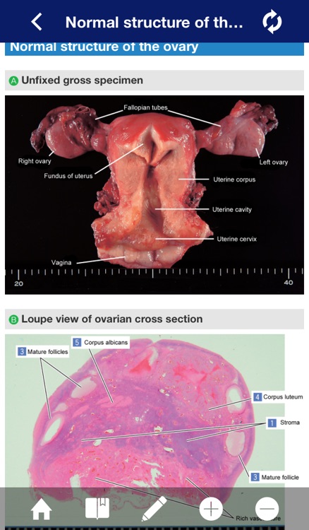 ATLAS OF PATHOLOGY And Comparison With Normal Anatomy Lite