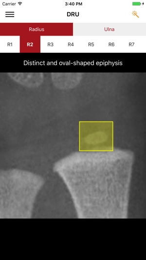 DRU - Distal Radius & Ulna Classification(圖4)-速報App