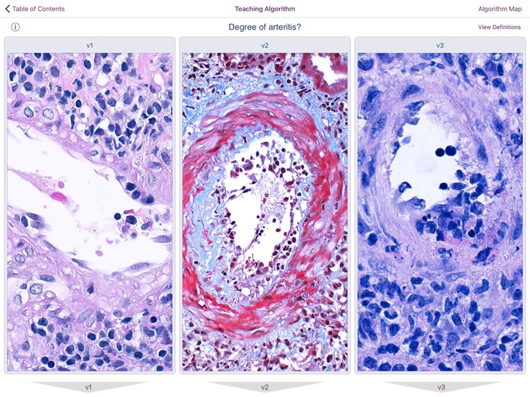 Renal Transplant Pathology screenshot-6