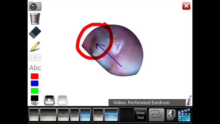 Otitis Media Disorders screenshot-4