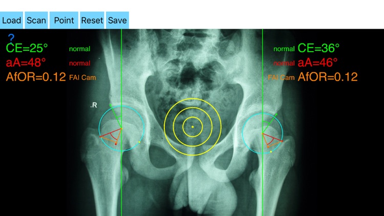 FemoroAcetabularImpingementApp screenshot-4