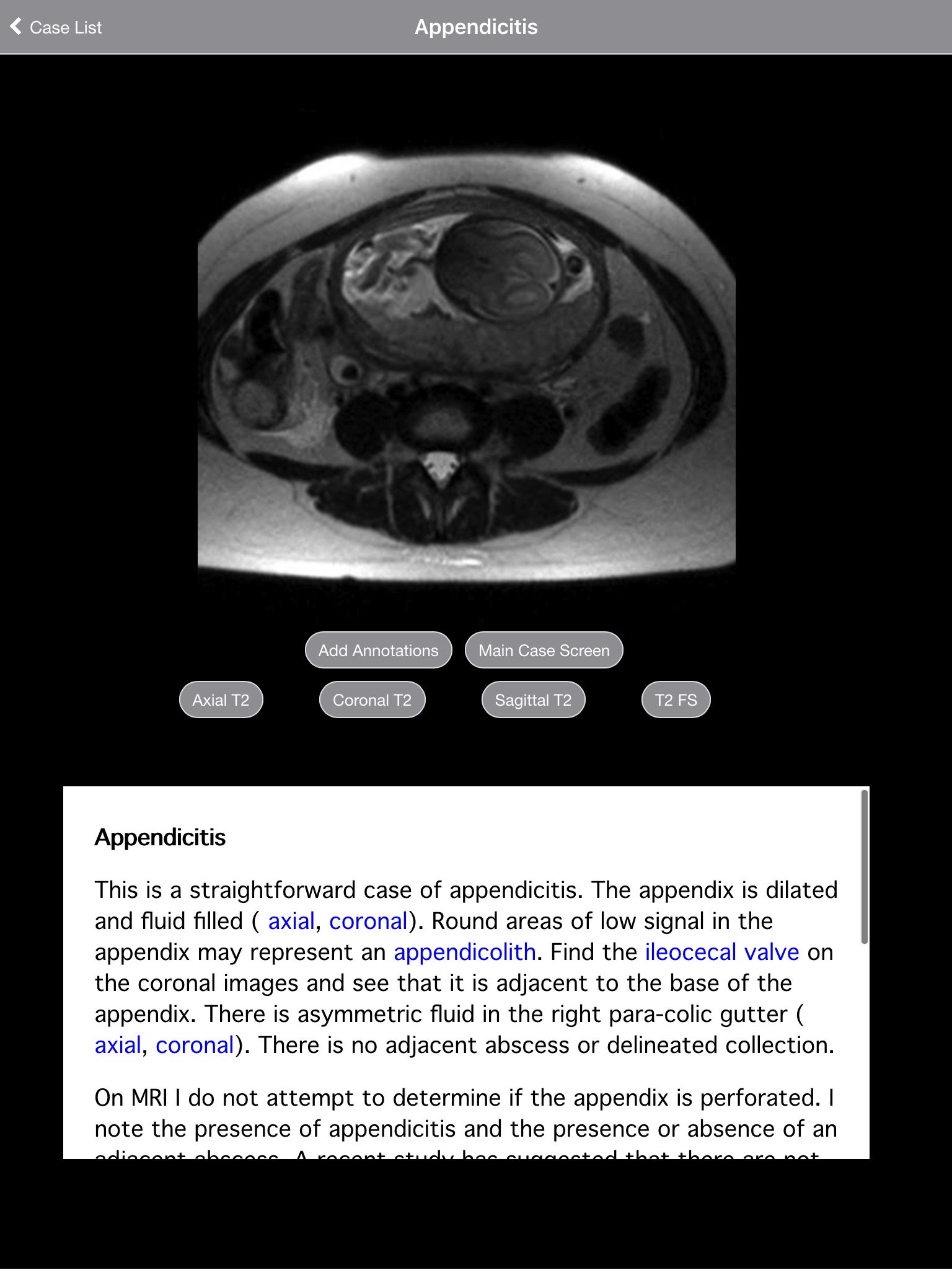 Pregnant Appendicitis screenshot 3