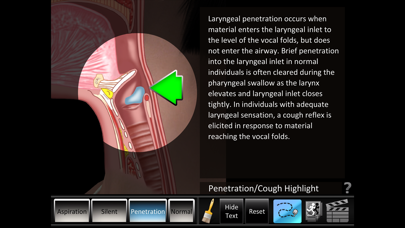 How to cancel & delete Aspiration Disorders from iphone & ipad 2