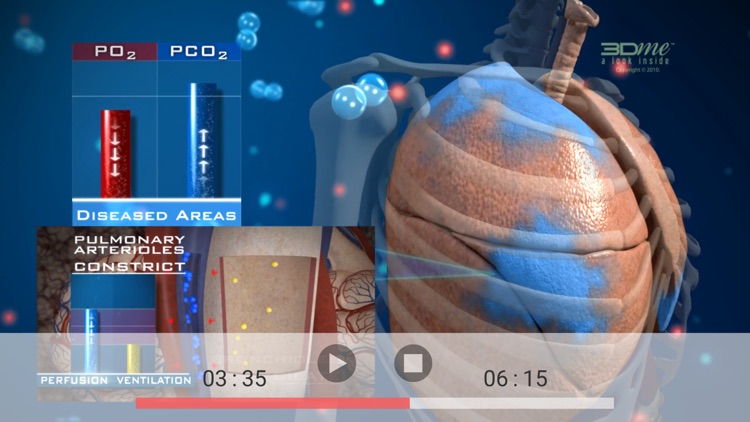 Ventilation Perfusion Matching