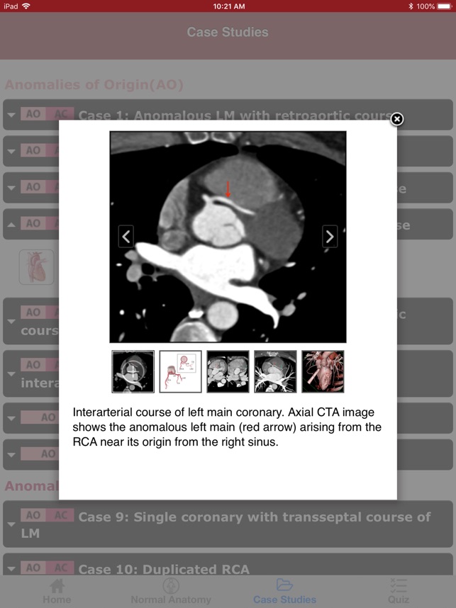 CTisus CT Coronary Arteries(圖5)-速報App