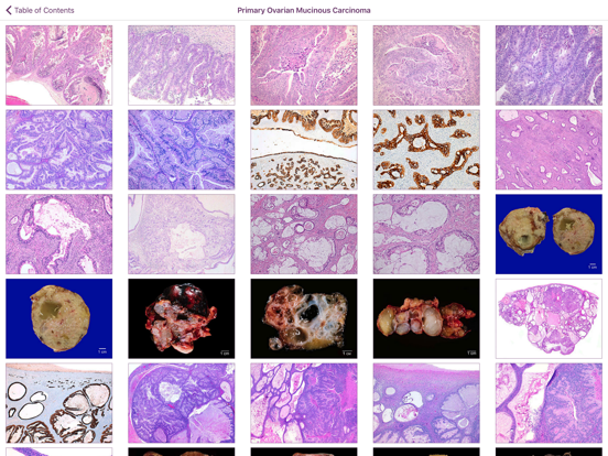 Ovarian Tumor Pathology screenshot 2