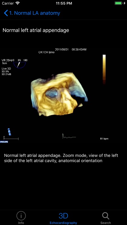 CARDIO3® 3D Echocardiography