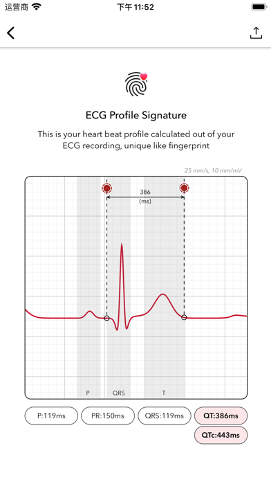 ECG+ Analyzer for QT/QTc & HRV screenshot 3