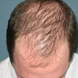 How To Treat Thinning Hair