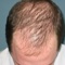 This is a series of 115 educational and informative videos on thinning and balding hair and various courses of treatment