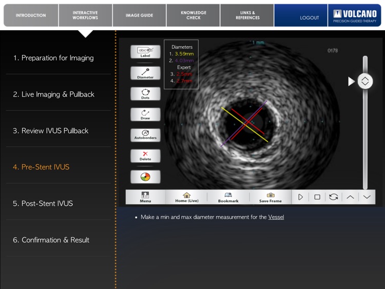 Coronary IVUS Essential Training