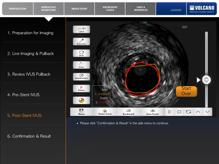Coronary IVUS Essential Training screenshot-3