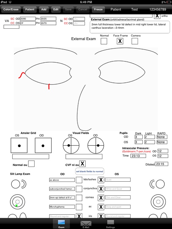 OphthyChart