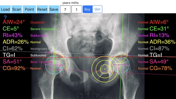 HipDysplasiaApp screenshot-0