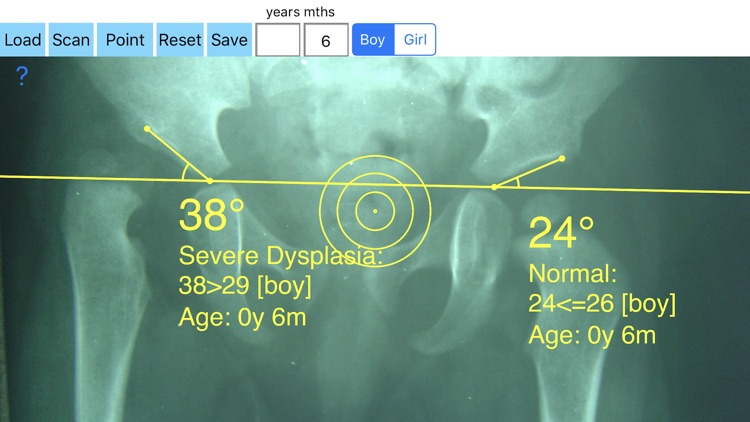 AcetabularIndex screenshot-4