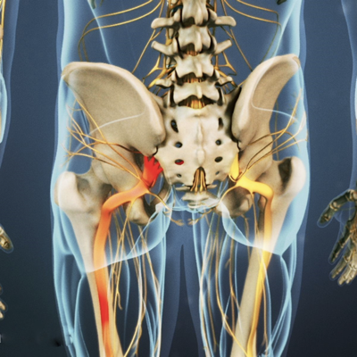 Sciatic Pain Relief