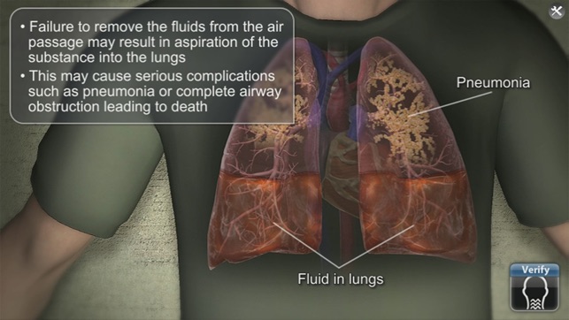 Medrills: Suctioning Airway(圖5)-速報App